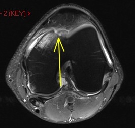 Figure 2 for case Osteochondral fracture femur with displaced fragment